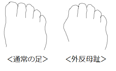 外反母趾が原因 靴の内側同士がこすれる現象について Try Tomo